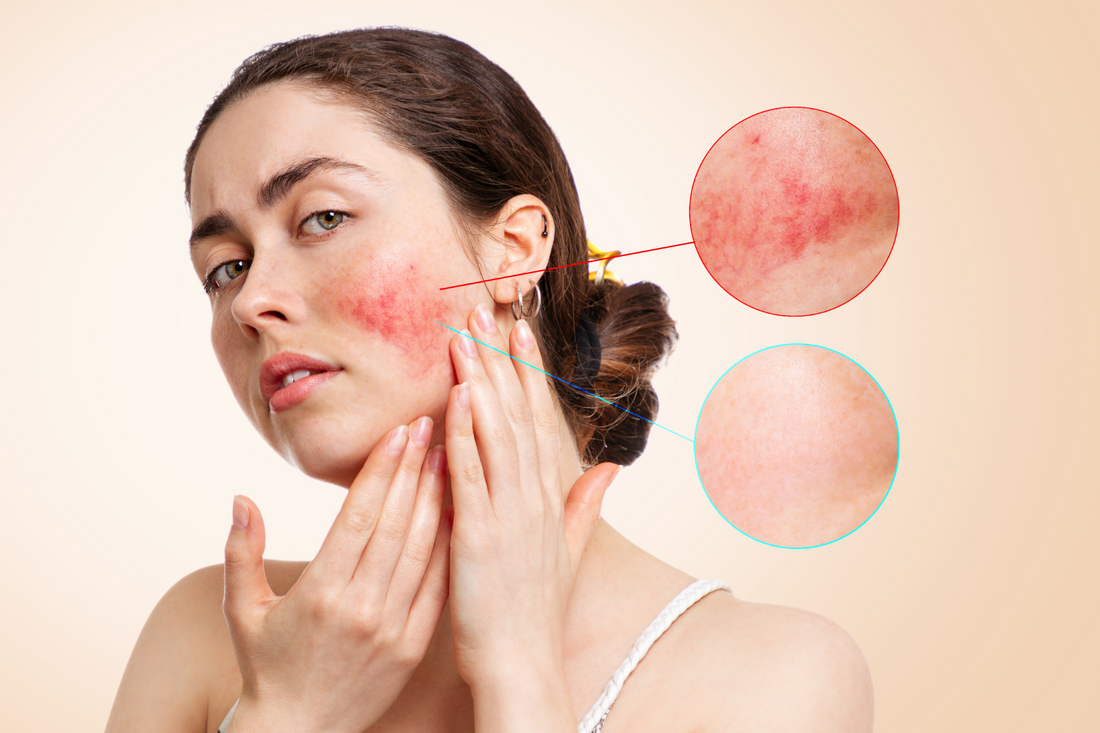 Couperose oder Rosacea – Rote Äderchen im Gesicht