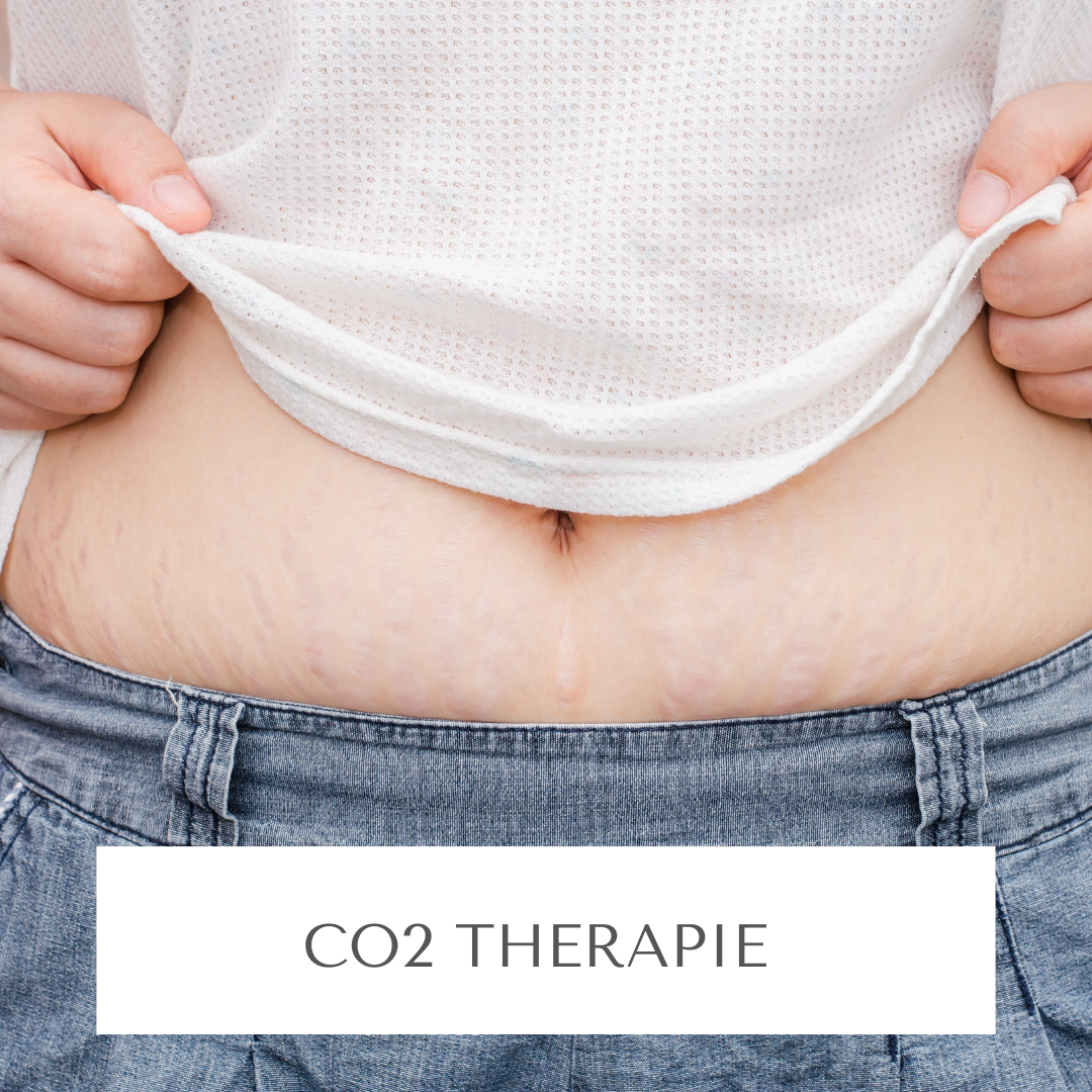CO2 Therapie bei Dehnungsstreifen und Hautrissen