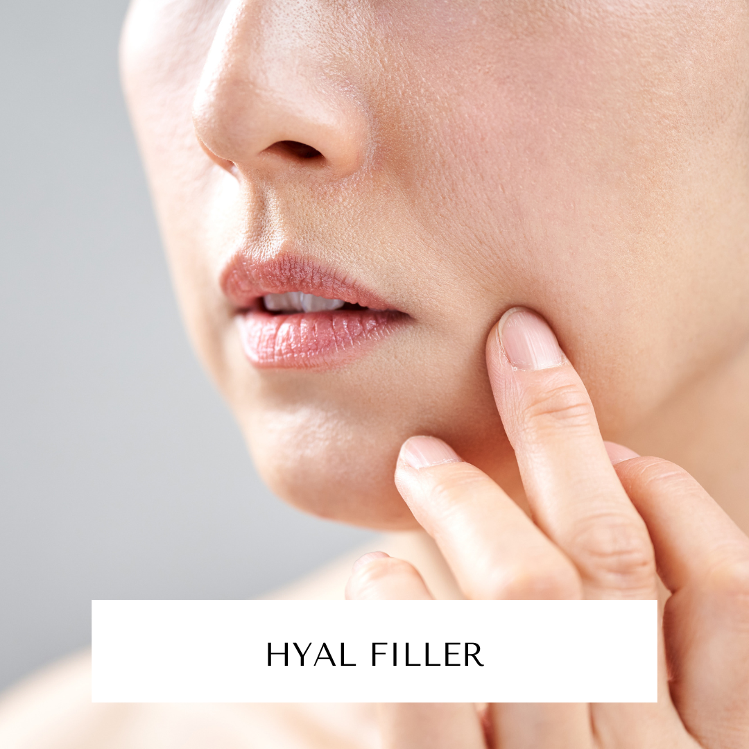 Hyal Filler - für Nasolabial- u. Marionettenfalten